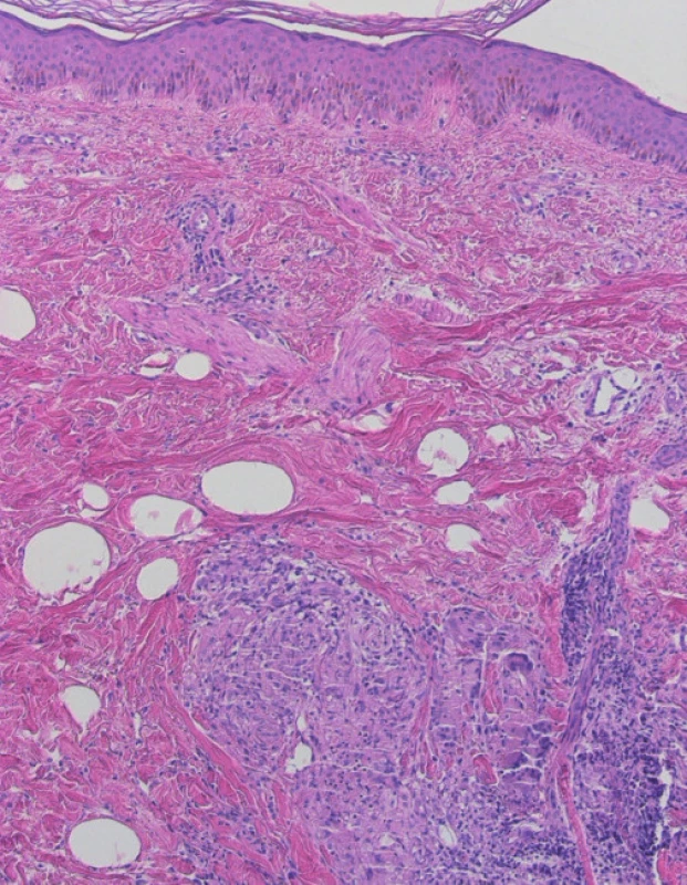 Nekaseifikující „nahé“ granulomy v dermis, obrovské mnohobuněčné buňky Langhansova typu s věncem jader.