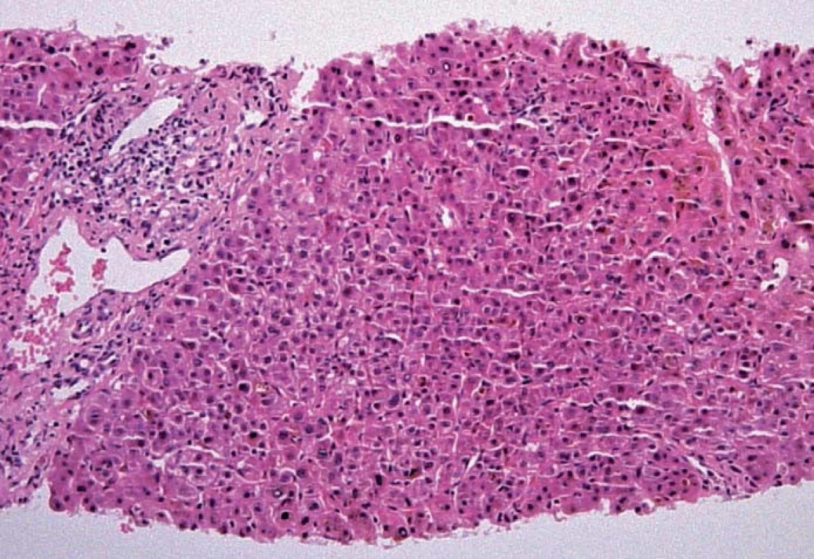 Histologický obraz akutní a subakutní cholestázy (HE 100×, bez morfologických známek typických pro PSC).
Fig. 4. Histological image of acute and subacute cholestasis (HE 100×, no morphological signs typical of PSC).