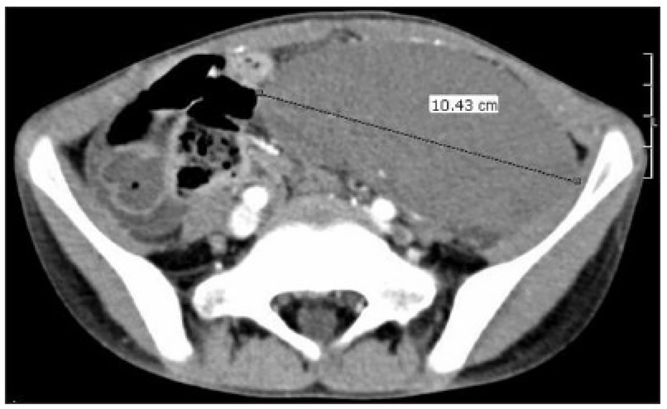 CT obraz dystopicky lokalizovanej sleziny v ľavom podbrušku
Fig. 1. CT image of dystopic spleen
