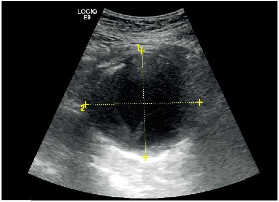Aneurysma břišní aorty v transverzální projekci