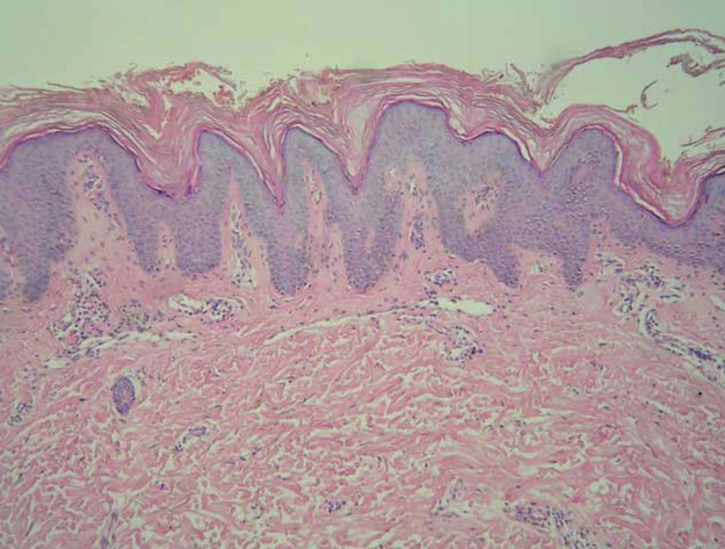 Histologie – případ 2: výrazná hyperkeratóza, akantóza a výrazná papilomatóza, nepatrná hyperpigmentace stratum basale epidermálních výběžků (HE, zvětšení 100krát).