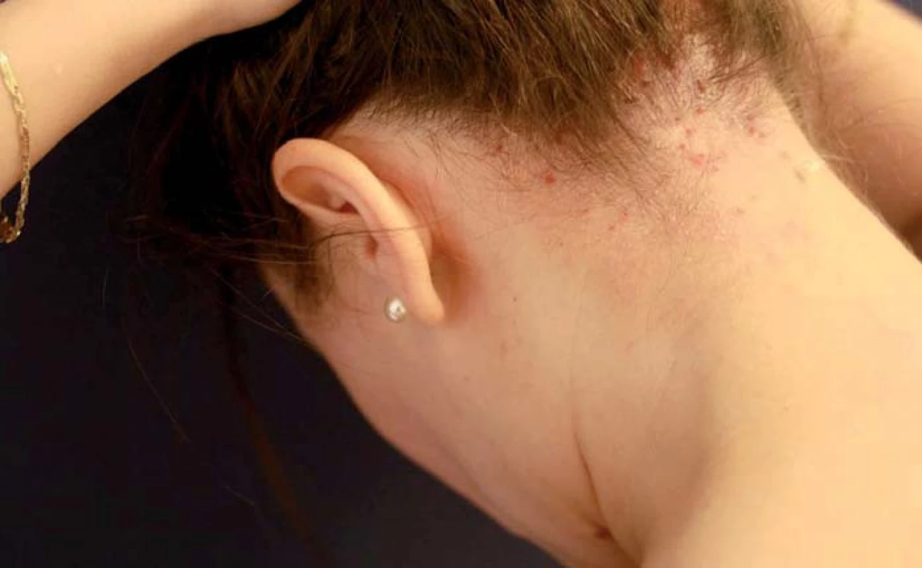Atopická dermatitida ve kštici.
Fig. 3. Atopic dermatitis on scalp.
