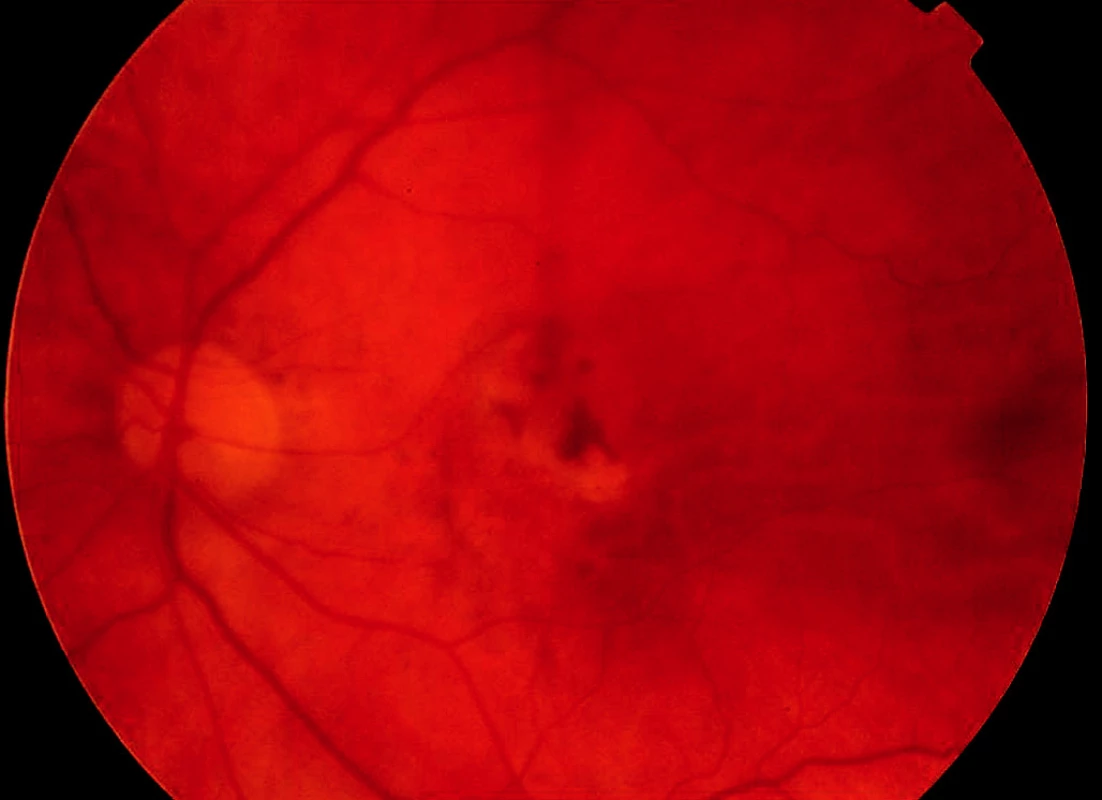Barevný snímek fundu levého oka pacienta 18 měsíců po skončení studie ANCHOR