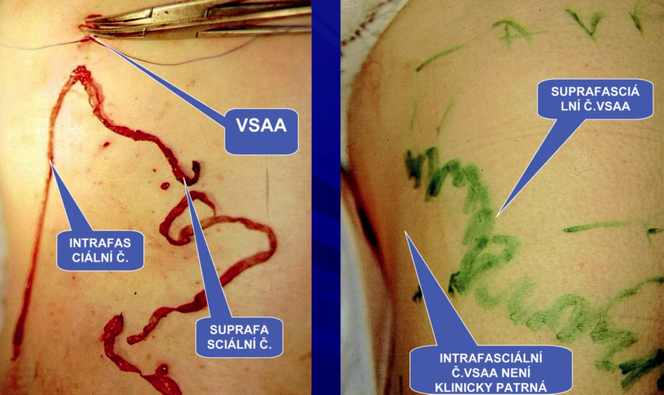 Safénový komplex typ I – intrafasciální flebektomie VSAA, která je uložena mimo HS, ligatura intrafasciální části VSAA v oblasti horní třetiny stehna v úrovni HS a její intrafasciální a superficiální část po extrakci