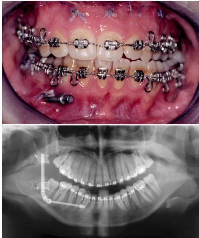 5a and 5b. Submucosally positioned intraoral distractor