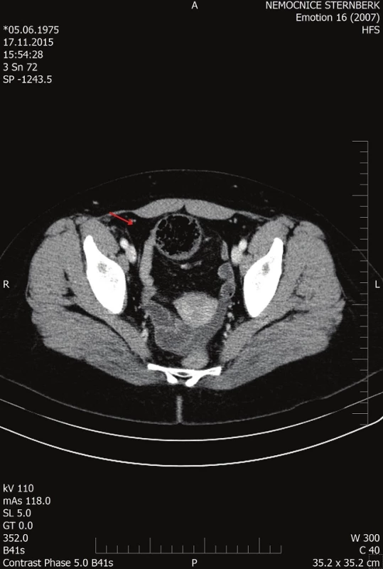 CT dilatované tenké kličky
Fig. 2: CT of the dilated small bowel loop