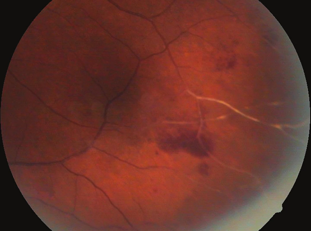 Pacient č. 2 – Ischemická retinální okluze a v sousedství počínající nekróza na sítnici – viz FAG (srpen 2009)