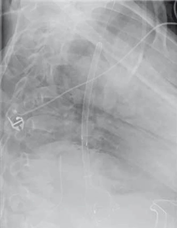 Extrakce Danišova stentu – radiologický obraz.
Fig. 3. Extraction of Danis stent – radiology image.