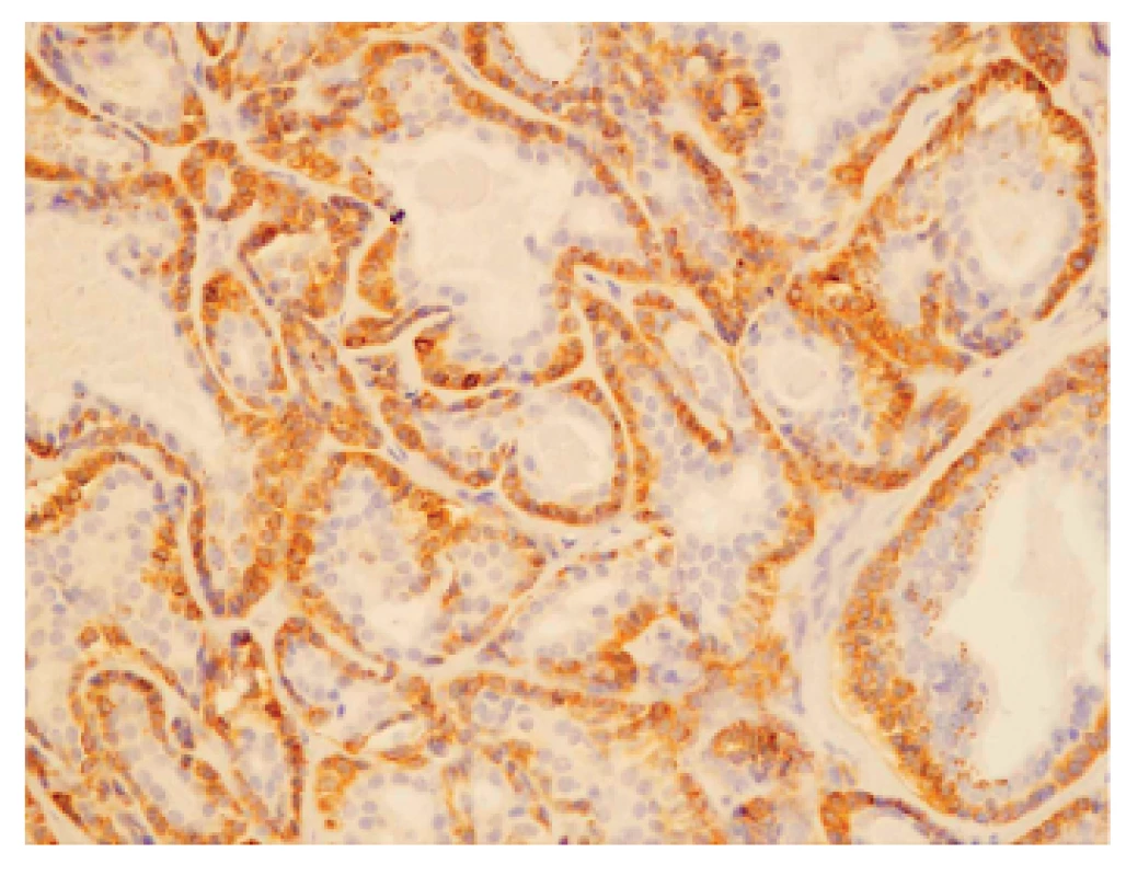 Primárny pleomorfný adenóm – epiteliálna komponenta. Silná imunopozitivita bcl-2 proteínu vo vonkajšej vrstve buniek štruktúr napodobňujúcich exkretorické dukty. Luminálne bunky sú negatívne (x 200).