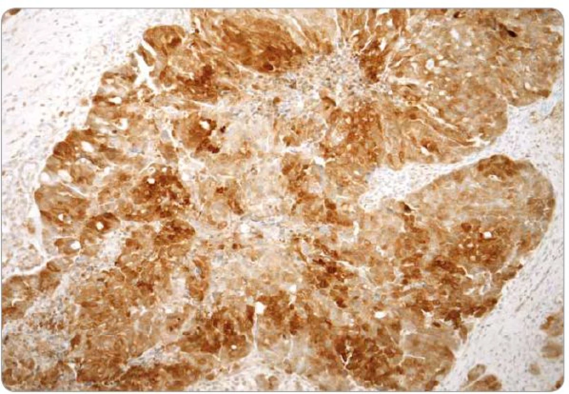 Difuzní exprese MRP1 v nádorových buňkách high-grade serózního karcinomu ovaria (imunohistochemie, zvětšení 100x).