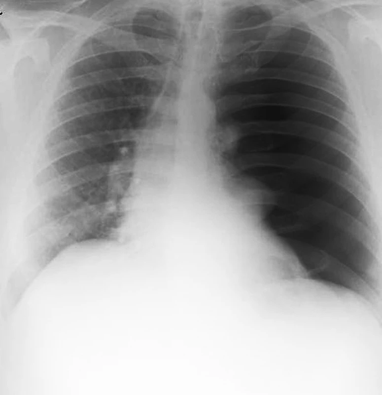Snímek hrudníku odhalující kompletní levostranný kolaps plíce s přesunem mediastina na pravou stranu
Fig. 1: Chest radiography showing complete left-sided collapse of the lung and shift of the mediastinum to the right