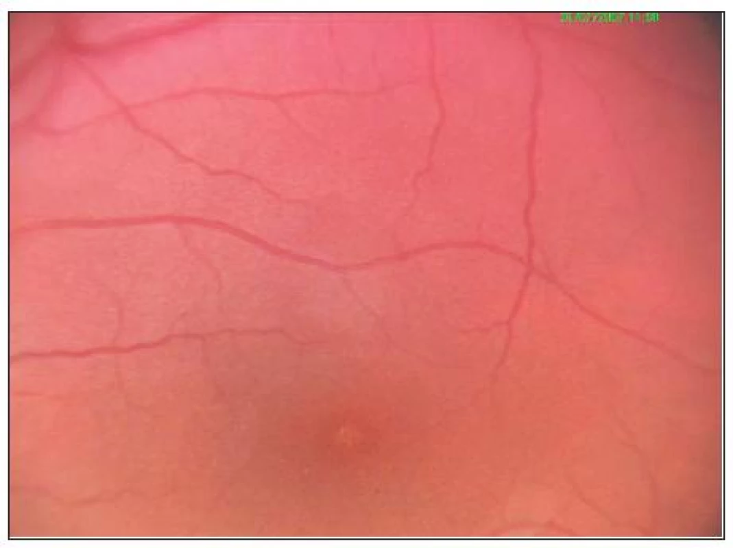 Detail makuly – zmeny na retinálnom pigmentovom epiteli – 1 mesiac po úraze