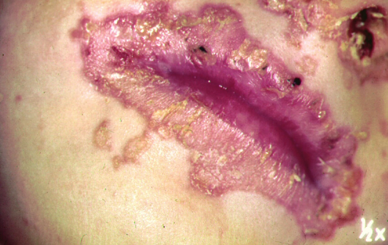 Kožní změny při acrodermatitis enteropathica.