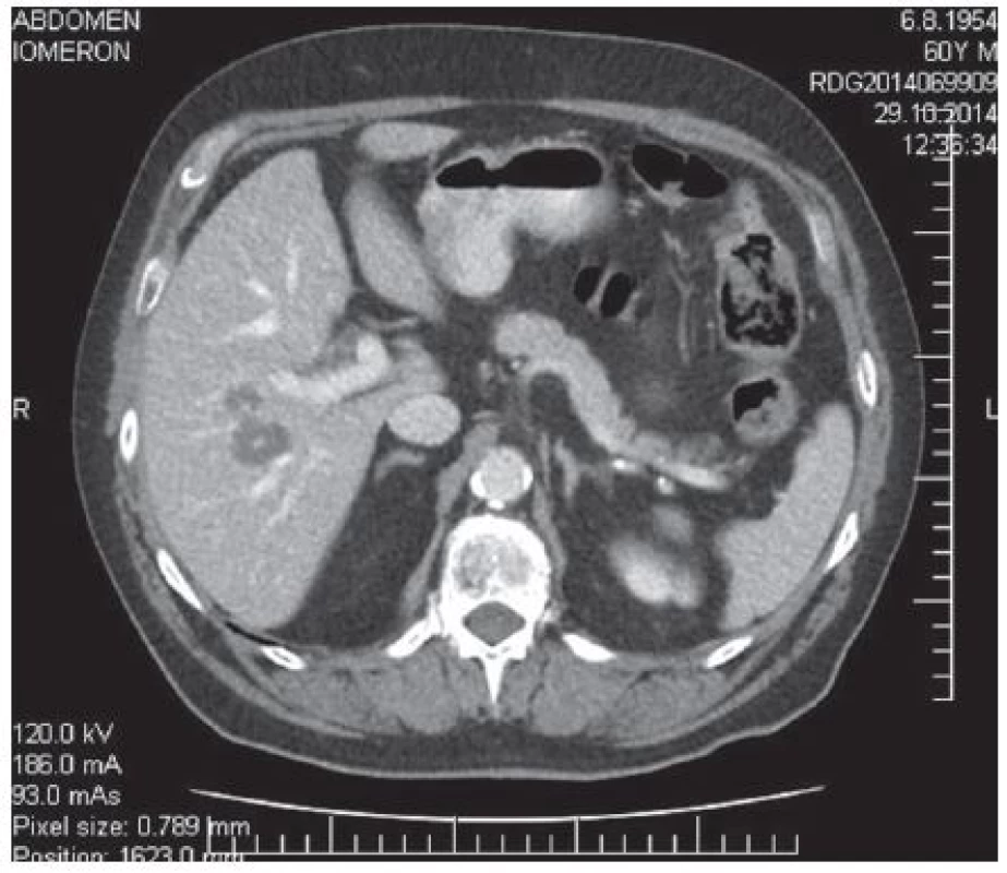 Předoperační CT vyšetření – není difuzní jaterní postižení
Fig. 2: Preoperative CT scan – no diffuse liver lesions