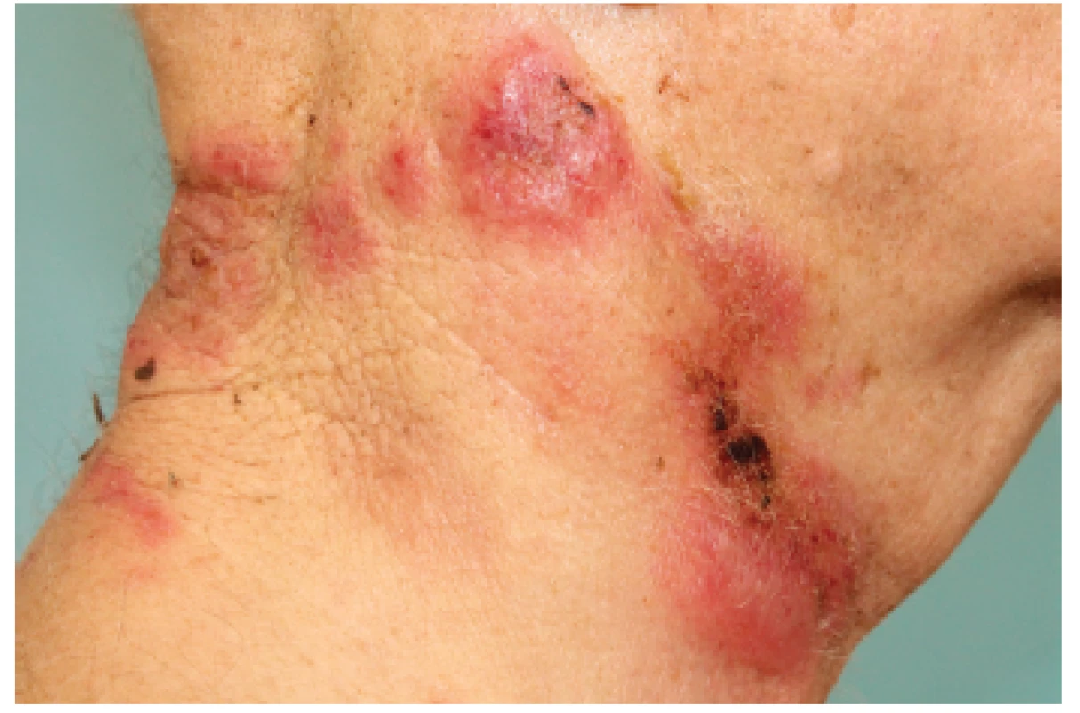 Palpačně bolestivé infiltráty na kůži krku, některé anulárního uspořádání