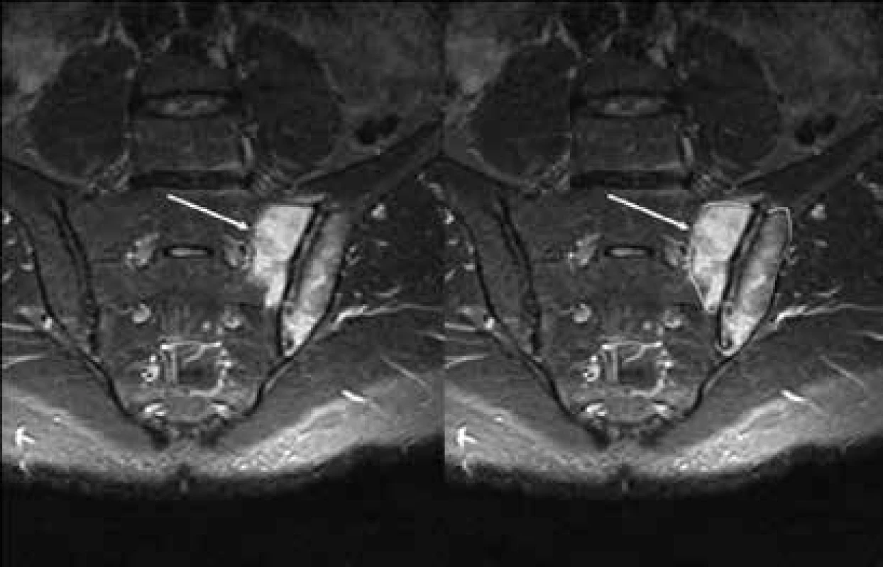 MRI STIR sekvence – vlevo periartikulárně na sakrální i ilické straně rozsáhlý edém kostní dřeně