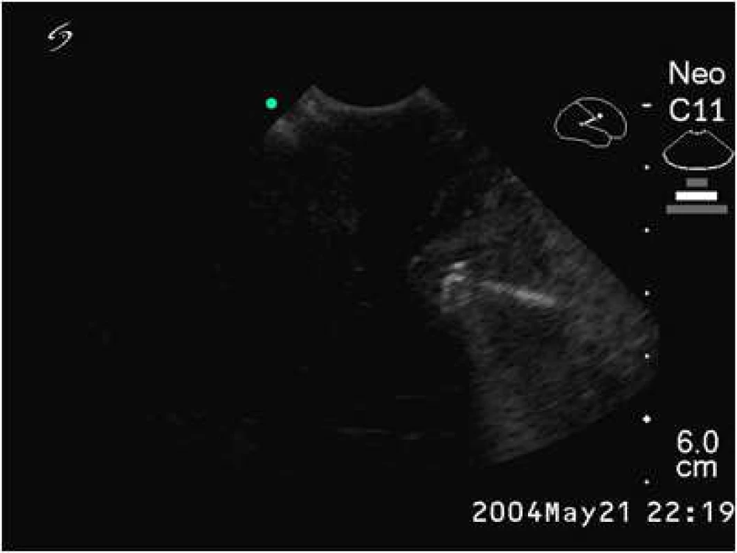 Peroperační 2D ultrazvuk: lokalizace cizího tělesa v levé hemisféře