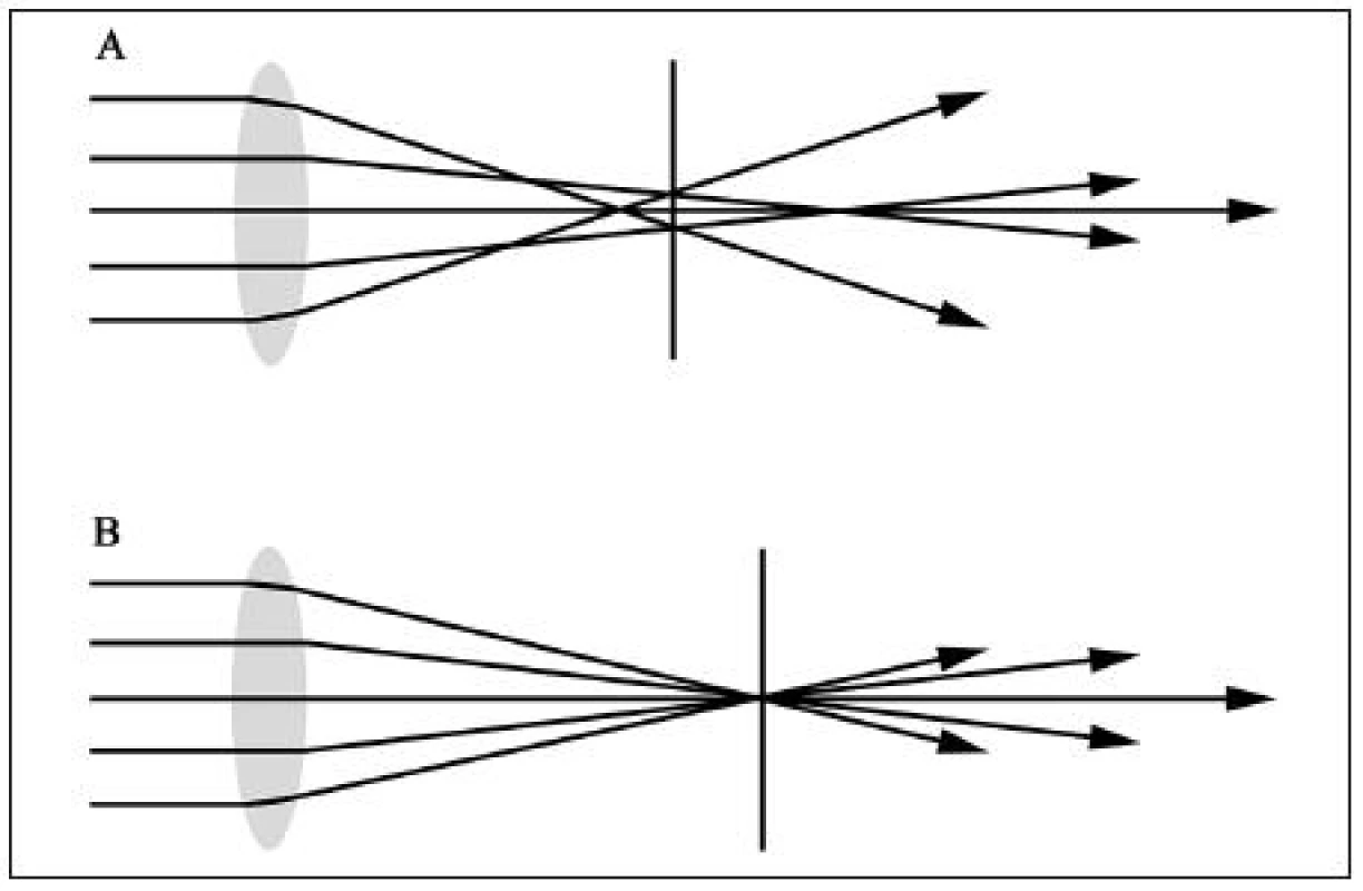 Schematické znázornenie sústredenia lúčov svetla mimo centrálnej optickej zóny pri A: sférickej šošovke, B: pri asférickej šošovke
