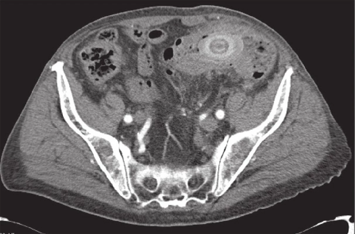 CT obraz – tumorózní stenóza colon sigmoideum s obstrukcí biliárním konkrementem
Fig. 2: Tumour-like stenosis of the sigmoid colon with gallstone obstruction (computed tomography finding)