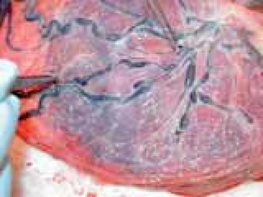 Anastomózy na povrchu placenty (převzato od Eurofoetus group).