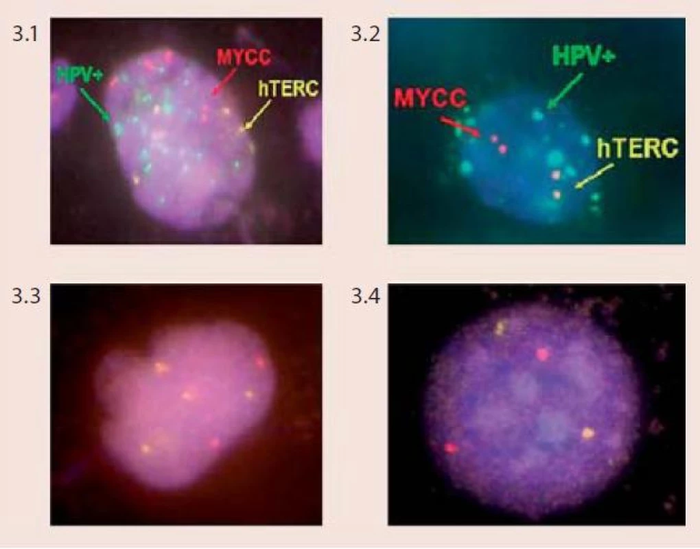 Klasifikace pacientů do jednotlivých rizikových skupin značením lidských papilomavirů (HPV), stanovením amplifikací genů hTERC a MYCC při použití Vysis Cervical FISH Probe Kit (foto Laboratoř molekulární cytogenetiky ÚEB PřF Brno)
Obr. 3.1 HPV-pozitivní buňka (zelené signály) se zmnožením kopií genu hTERC (více než dva žluté signály) a genu MYCC (víc než dva červené signály) – klasifikováno jako vysoce rizikové (High Risk – HR)
Obr. 3.2 HPV-pozitivní buňka (zelené signály) bez aberací u genu hTERC (dva žluté signály) a genu MYCC (dva červené signály) – klasifikováno jako střední riziko (Intermedium Risk – IMR)
Obr. 3.3 HPV-negativní buňka (žádné zelené signály) se zmnožením kopií genu hTERC (více než dva žluté signály) a genu MYCC (více než dva červené signály) – klasifikováno jako vysoce rizikové (High Risk – HR)
Obr. 3.4 HPV-negativní buňka (žádné zelené signály) bez aberací u genu hTERC (dva žluté signály) a genu MYCC (dva červené signály) – klasifikováno jako nízké riziko (Low Risk – LR)