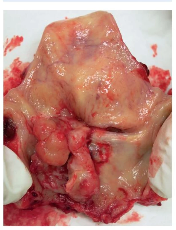 Zadní pohled na resekát laryngu s tumorem levého hlasového vazu.