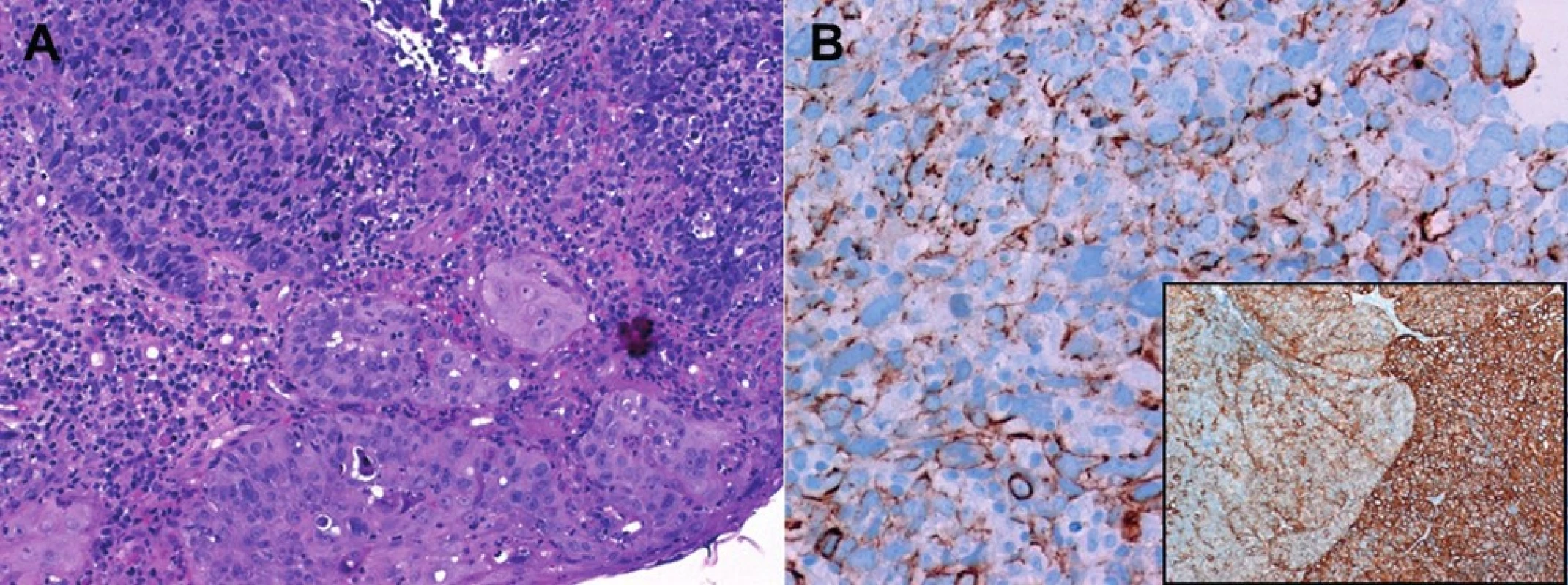 Conventional basaloid SCC of the sinonasal tract (A, upper field) associated with dysplastic surface epithelium. B: Cytokeratin 5/6 may show perinuclear pattern closely resembling the pattern of pan-CK seen in SCNEC (main image), but the tumor lacks any neuroendocrine marker reactivity. Subimage: overview of CK5/6 showing basaloid component (left) abutting conventional SCC component (right).