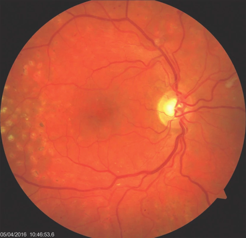 Nález klidné diabetické retinopatie se vstřebanými exsudacemi za 15 měsíců po operaci