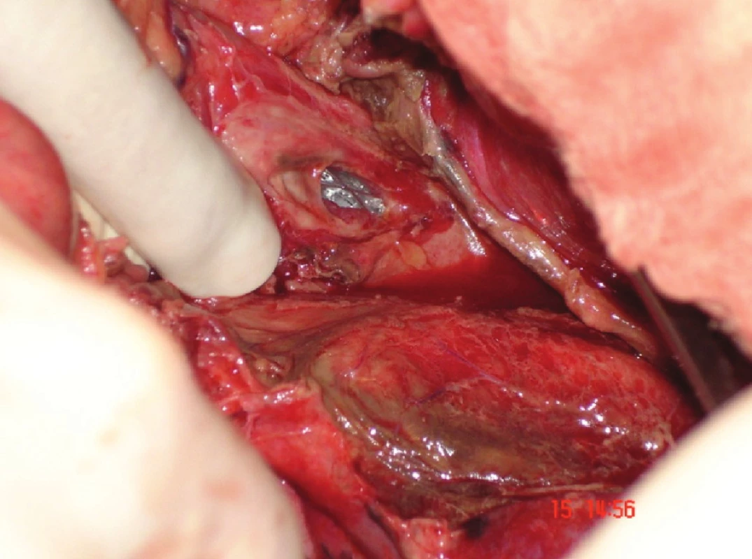 Peroperačně zavedený stent (pacienta z Obr. 1) – následovala sutura jícnu posílená fundoplikací
Fig. 2: A stent applied surgically (patient in Fig. 1) – followed by oesophageal suture supported by fundoplication