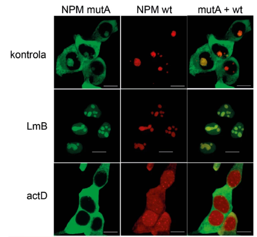 Změny lokalizace mutovaného (zelená) a nemutovaného (červená) nukleofosminu v HEK293T buňkách po působení leptomycinu B (LmB) a aktinomycinu D (actD)