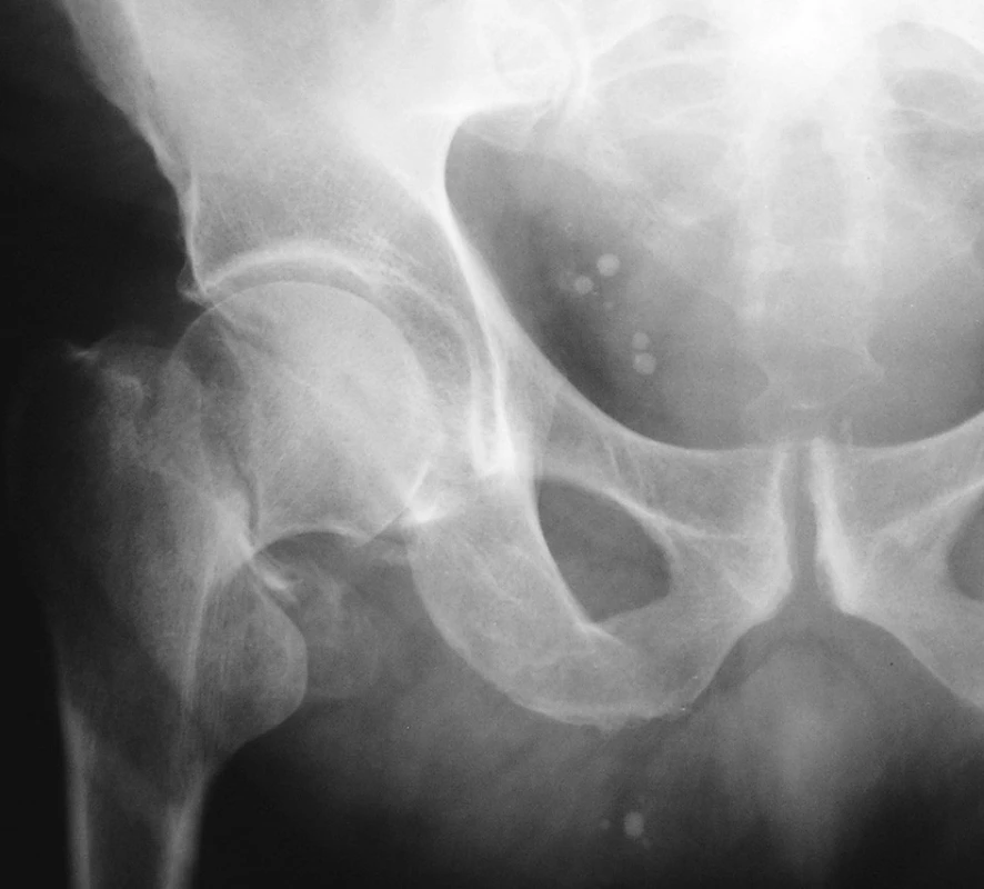 Zlomenina krčku pravé stehenní kosti
Fig. 1. Fracture of femoral neck right