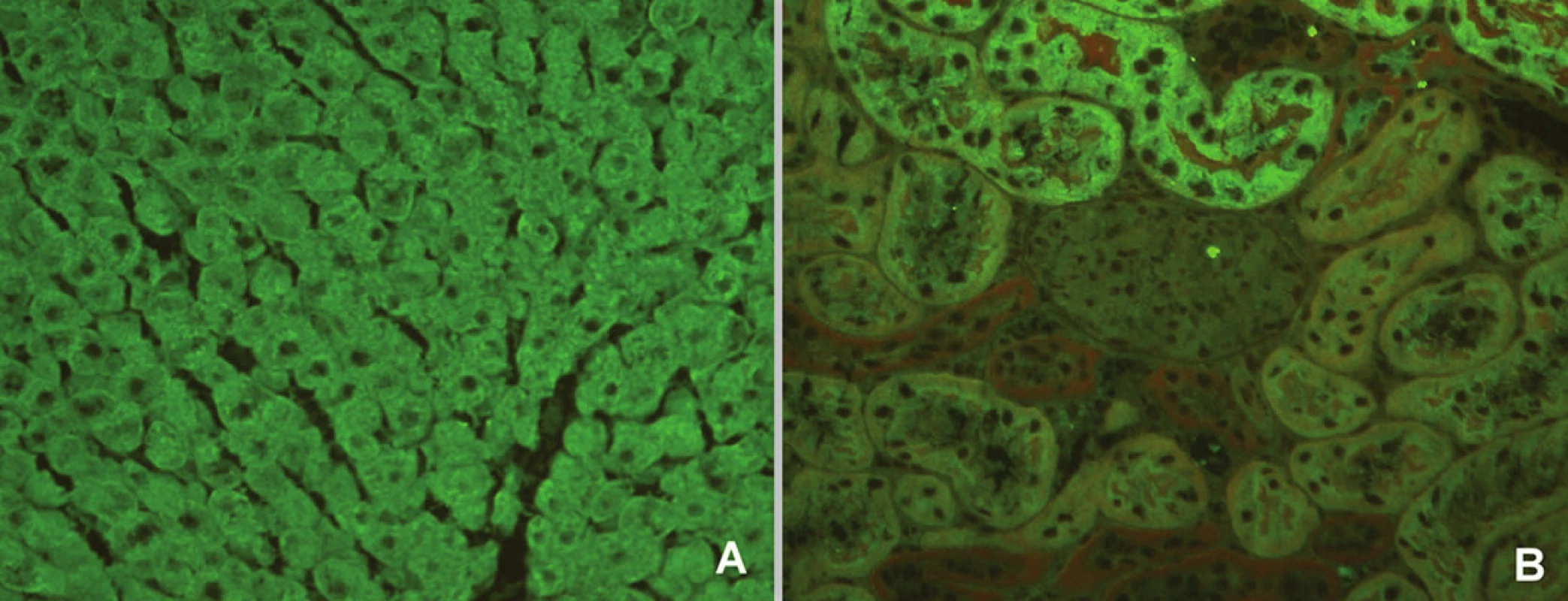 Imunofluorescenční obraz protilátek proti mikrozomálnímantigenůmjater a ledvin 1 (substrát – krysí játra a ledvina, A – jaterní buňky, B – proximální tubuly).
Fig. 5. Immunofluorescent image of anti-liver kidney microsome antibodies 1 (substrate – rat liver and kidney, A – liver cells, B – proximal tubules).
