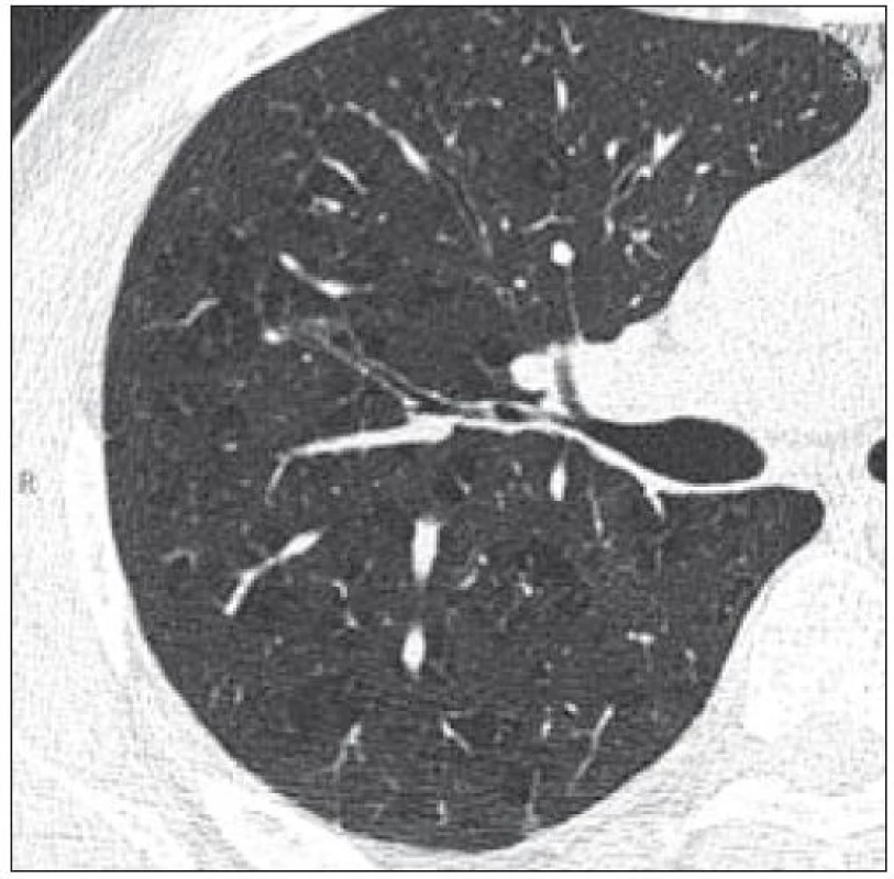 Pacient narozený 1972, HRCT ze dne 3. 7. 2009. Na obraze jsou zřetelná četná ložiska nižší denzity bez definovatelné stěny centrilobulárně lokalizovaná, neodlišitelná od centrilobulární formy emfyzému.