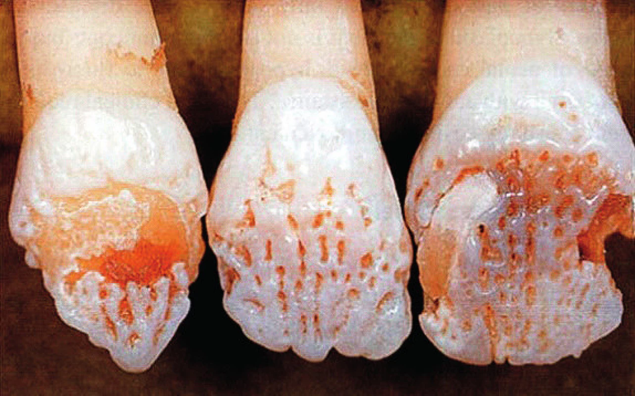 Hypomineralizace skloviny (amelogenesis imperfecta). (dle: Cawson RA, Odell EW, Porter S. Cawson´s Essentials of Oral Pathology and Oral Medicine. Churchill Livingstone, 2008. ISBN 0 443 071055).
Fig. 1. These teeth an affected female show the typical vertical ridged pattern of normal and abnormal enamel as a result of lyonisation.