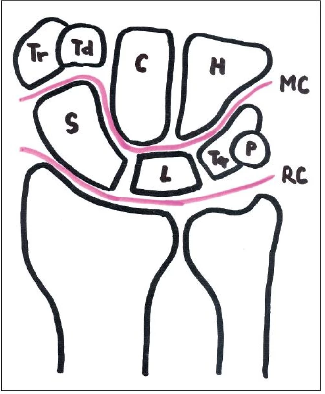 Schéma zápěstního kloubu: S – os scaphoideum, L- os lunatum, Tq – os triquetrum, P – os pisiforme, Tr – os trapezium, Td – os trapezoideumm C – os capitatum, H- os hamatum, RC – radiokarpální kloub, MC – medikarpální kloub. 