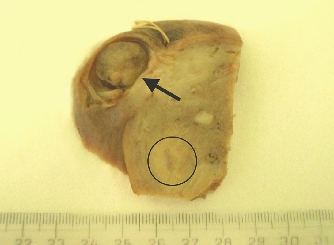Subserózne uložený uzlovitý nádor (označený šípkou). V krúžku je označený roh maternice