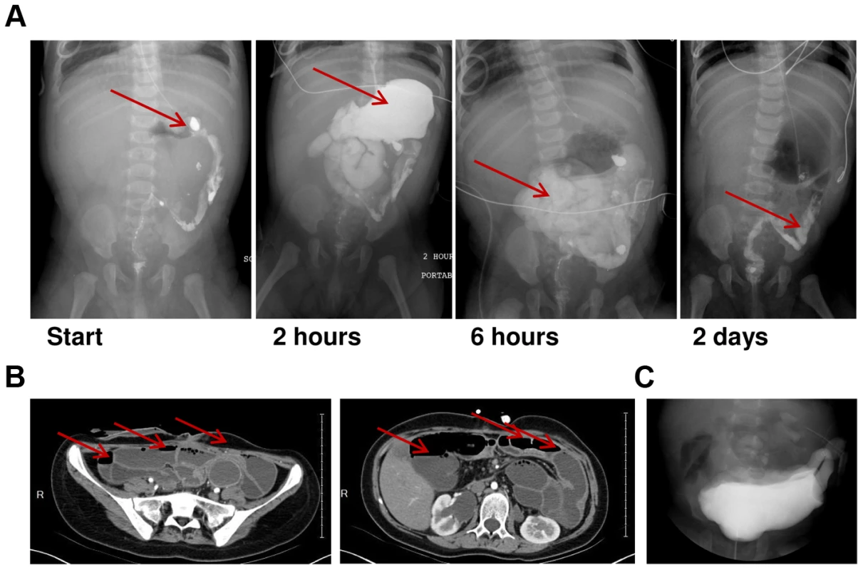 Radiologic features of MMIHS due to <i>de novo ACTG2</i> mutations.