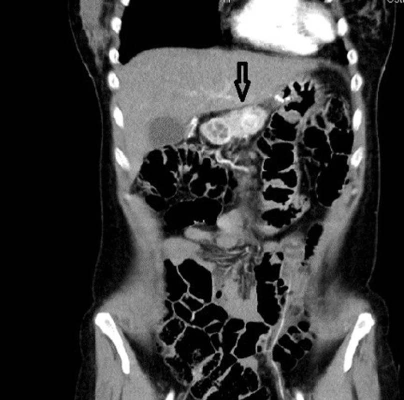 Léze v oblasti pankreatu u pacienta s MEN 1
Fig. 1: Pancreatic lesion in a patient with MEN 1