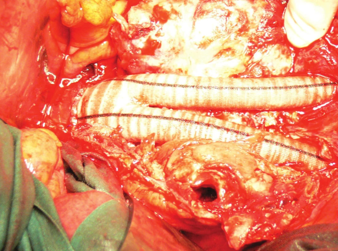 Aortobiilická náhrada, v nástěnném trombu patrný kanál po endoleaku
Fig. 12: Aortobiiliac replacement, in wall thrombus visible channel for endoleak