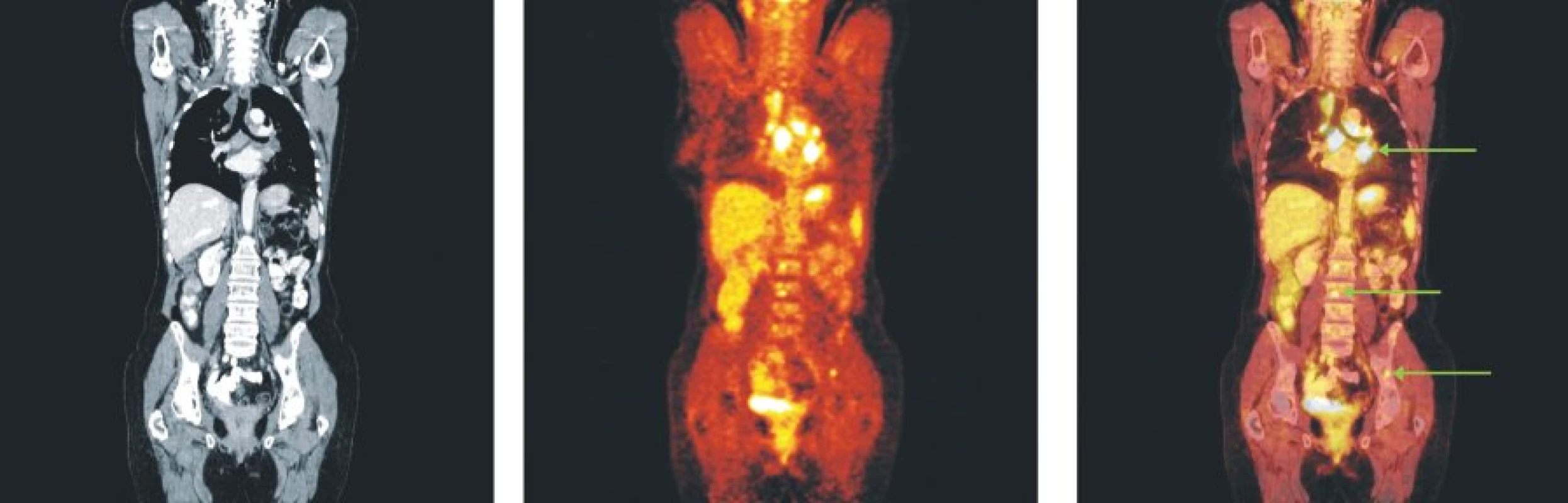 Snímky výpočetní tomografie (CT), pozitronové emisní tomografie (PET) a PET/CT u nemocného s folikulárním lymfomem stupně 3b a postižením lymfatických uzlin mediastina, skeletu páteře a pánve.