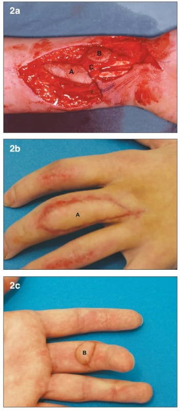 a. Bilobed arterialized venous flap. Flap harvested on the distal
volar forearm (7) A– Dorsal skin paddle. B – Volar skin paddle. C – subcutaneous bridge
between the two skin paddles
b. Early post-operative result at 1 month. A – Dorsal skin paddle
c. Early post-operative result at 1 month. B – Volar skin paddl