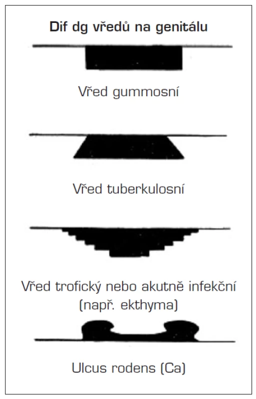 Schéma vzhledu vybraných vředů (upraveno dle Jiráska a Šťávy)
Štáva Z., Jirásek L. Dermatovenerologie. Avicenum, 1982