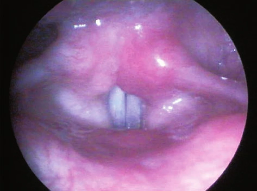 Laryngoskopický obraz: a) dechová pozice hlasivek po hlasové terapii, b) fonační pozice hlasivek po hlasové terapii.