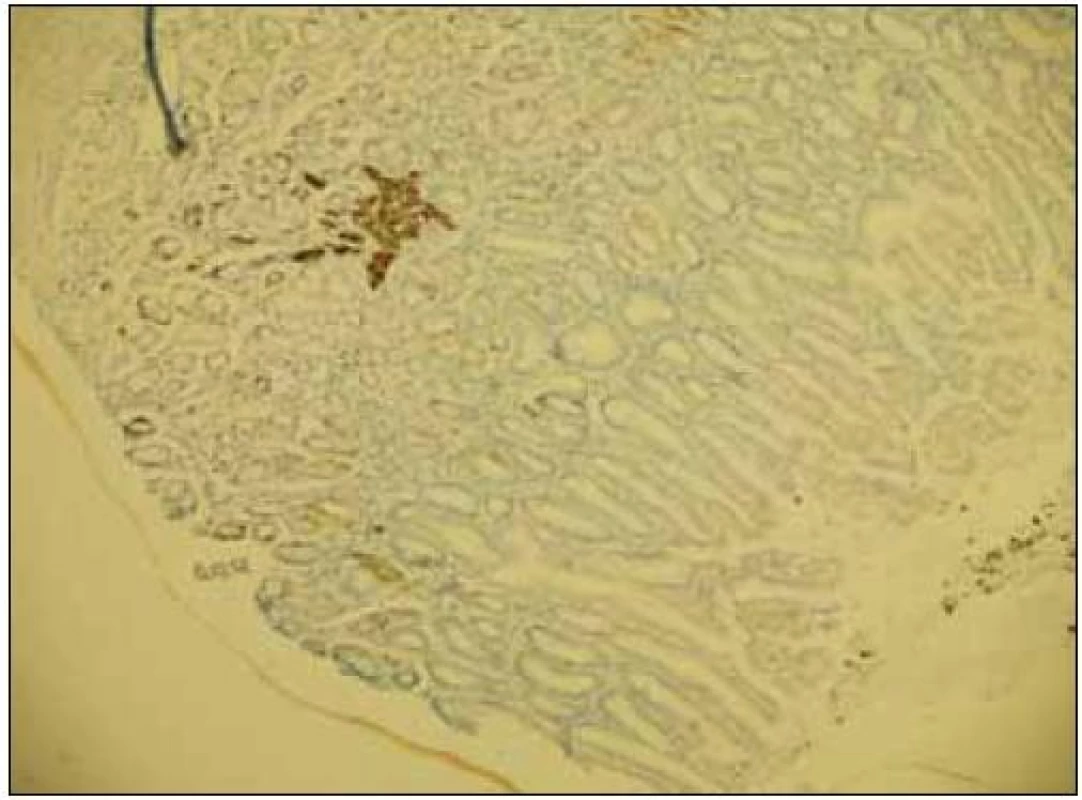 Imunohistochemické vyšetření – chromogranin A, zvětšení 100krát. Hyperplazie endokrinních buněk (hnědá barva) až ve formě drobných ostrůvků.
