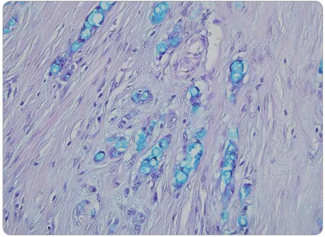 Přítomnost intracelulárního hlenu ve vakuolizovaných nádorových buňkách, metodika na průkaz kyselých mukopolysacharidů. Barvení alciánová zeleň, zvětšení 400krát.