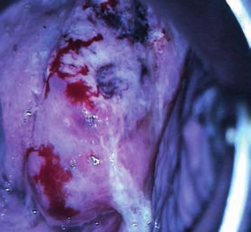Kazuistika 3. Horní část ektocervixu – hrubá makroskopická deformace objemného cervixu, zde již nekrotická tkáň, vysoce suspektní z HG-léze až stromální invaze