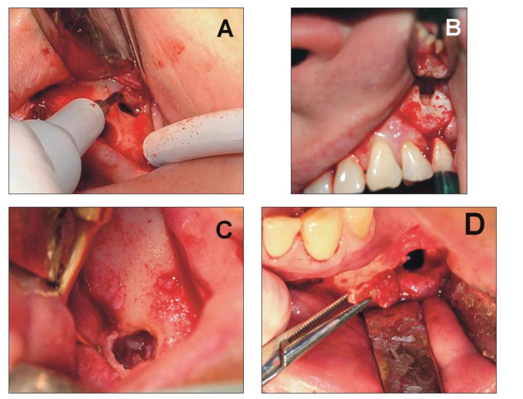 Piezochirurgie v dentoalveolární chirurgii.