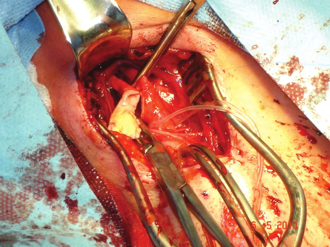ACI po endarterektomii a parciální resekci
Fig. 2: ICA after endarterectomy and partial resection
