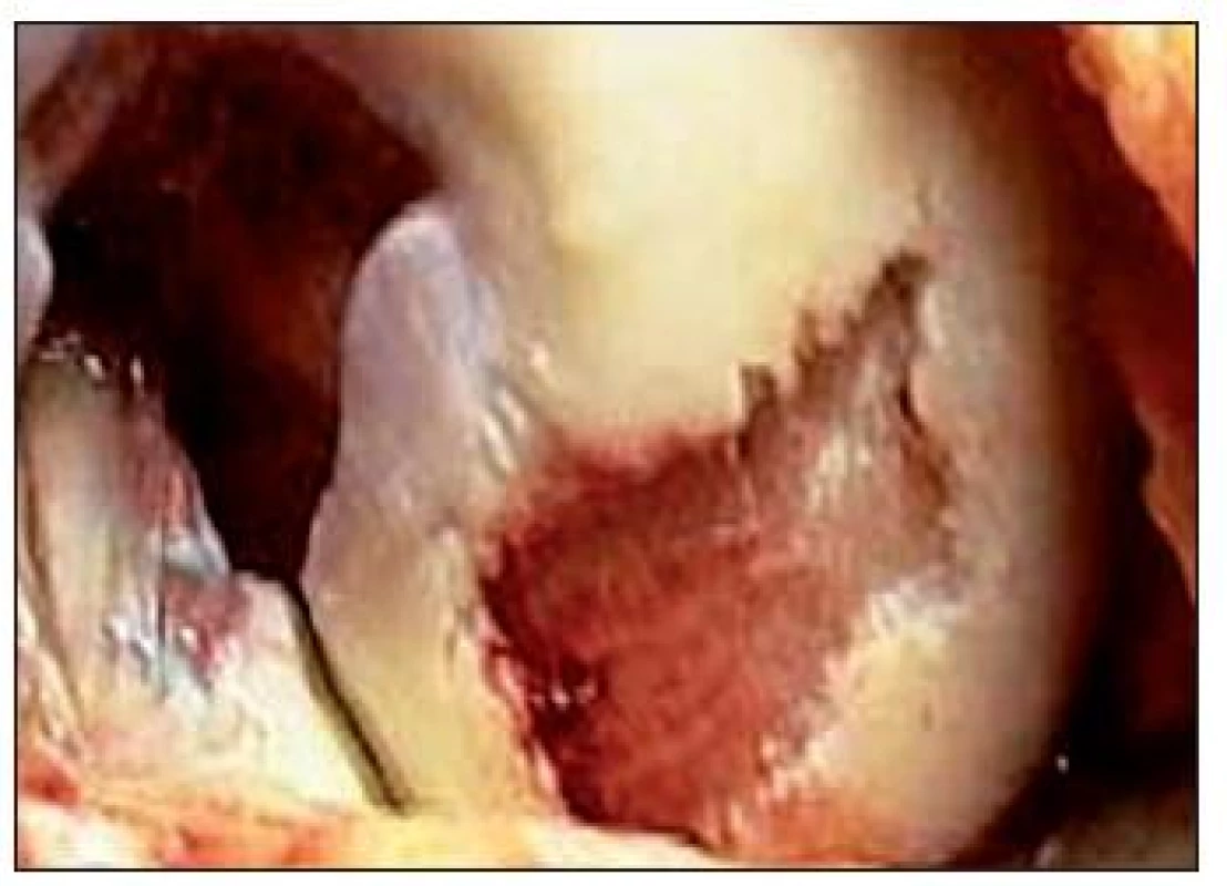 Rozsiahly chondrálny defekt postihujúci celú hrúbku chrupky lokalizovaný v nosnej časti mediálneho kondylu femoru
