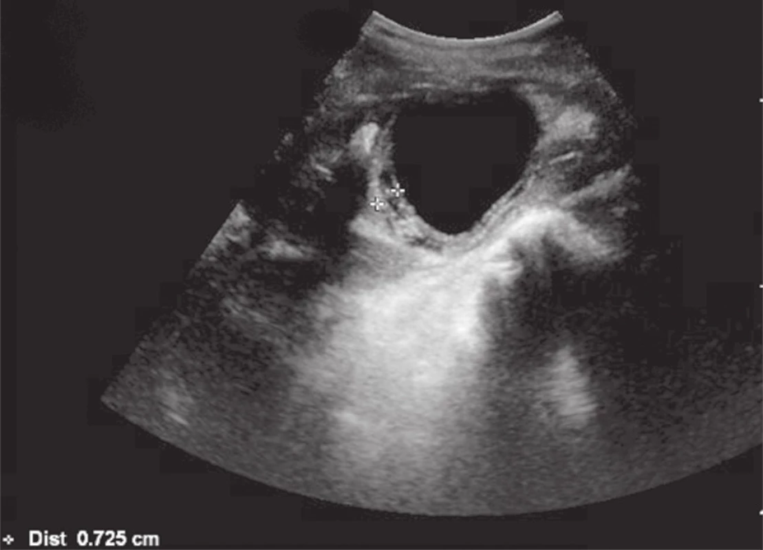 Ultrazvukový obraz dilatace stěny žlučníku na 7 mm
Fig. 2: Ultrasound image dilation of the gallbladder wall at 7 mm